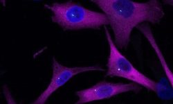 Células de melanoma. Un estudio ha identificado una proteína que, como un sistema GPS, es fundamental para guiar a las células tumorales de melanoma en su propagación por el organismo.Células de melanoma. Un estudio ha identificado una proteína que, como un sistema GPS, es fundamental para guiar a las células tumorales de melanoma en su propagación por el organismo.
