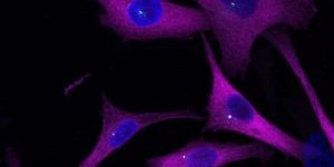 Células de melanoma. Un estudio ha identificado una proteína que, como un sistema GPS, es fundamental para guiar a las células tumorales de melanoma en su propagación por el organismo.Células de melanoma. Un estudio ha identificado una proteína que, como un sistema GPS, es fundamental para guiar a las células tumorales de melanoma en su propagación por el organismo.