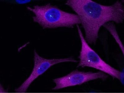 Células de melanoma. Un estudio ha identificado una proteína que, como un sistema GPS, es fundamental para guiar a las células tumorales de melanoma en su propagación por el organismo.Células de melanoma. Un estudio ha identificado una proteína que, como un sistema GPS, es fundamental para guiar a las células tumorales de melanoma en su propagación por el organismo.