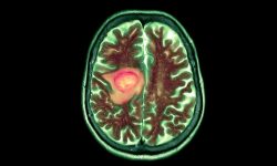 el farmaco vorasidenib aprobado por la FDA para el tratamiento de gliomas de grado 2