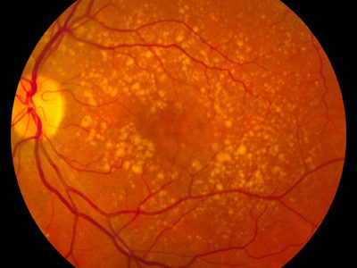 fondo-de-ojo-en-degeneracion-macular-ocular-asociada-a-la-edad