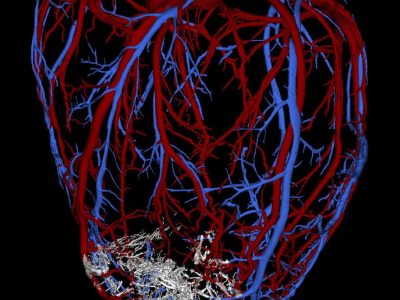 Vasculatura del corazón del macaco donde se muestra en blanco el injerto de cardiomiocitos realizado. Imagen cortesía del laboratorio del Dr Murry, Universidad de Washington