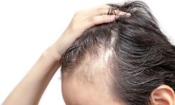 identificado un nuevo gen relacionado con la alopecia hereditaria monilethrix