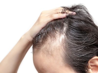 identificado un nuevo gen relacionado con la alopecia hereditaria monilethrix