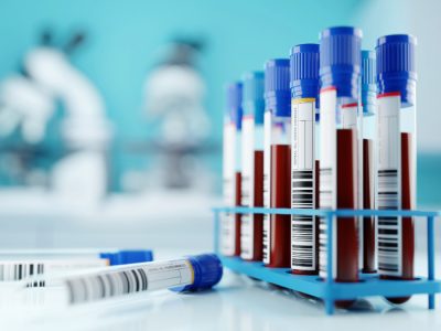 El nuevo biomarcador de Alzheimer podría identificar personas con la enfermedad en muestras de sangre, una aproximación más accesible para aplicaciones clínicas y de investigación. Imagen: Adobe Express.