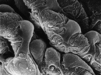Podocitos del riñón en un paciente con enfermedad renal crónica. Imagen : Matthias Kretzler, University of Michigan (Image and Video Gallery, Instituto Nacional de Salud EEUU)