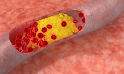 La estructura de una proteína aumenta riesgo cardiovascular en hipercolesterolemia familiar.