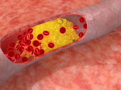 La estructura de una proteína aumenta riesgo cardiovascular en hipercolesterolemia familiar.