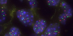 la proteína capicua está relacionada con la vulnerabildiad de algunos tratamientos para el cancer pulmón