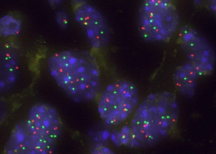 la proteína capicua está relacionada con la vulnerabildiad de algunos tratamientos para el cancer pulmón