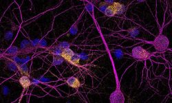 la proteína neuroprotectora PKD1 está reducida en las neuronas de pacientes con enfermedad de Huntington