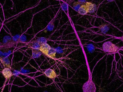 la proteína neuroprotectora PKD1 está reducida en las neuronas de pacientes con enfermedad de Huntington