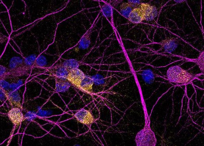 la proteína neuroprotectora PKD1 está reducida en las neuronas de pacientes con enfermedad de Huntington