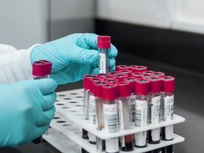 Un nuevo test desarollado por investigadores de xxx permite identificar en muestras de sangre dos tipos de mutaciones asociadas a la aparición de gliomas. Imagen: Fernando Zhiminaicela, Pixabay.