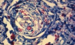 Fotomicrografía de una muestra de tejido de piel de un paciente con lepra. Se muestra un nervio cutáneo invadido por numerosas bacterias de Mycobacterium leprae. Imagen: Arthur E. Kaye, Centre for Disease Control. EE.UU.
