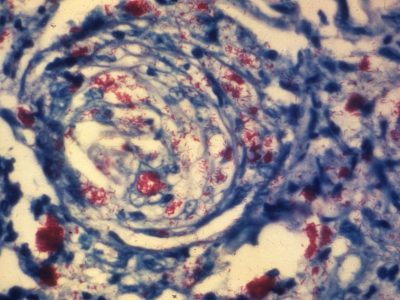 Fotomicrografía de una muestra de tejido de piel de un paciente con lepra. Se muestra un nervio cutáneo invadido por numerosas bacterias de Mycobacterium leprae. Imagen: Arthur E. Kaye, Centre for Disease Control. EE.UU.
