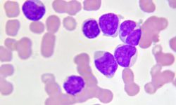 leucemia mieloide aguda