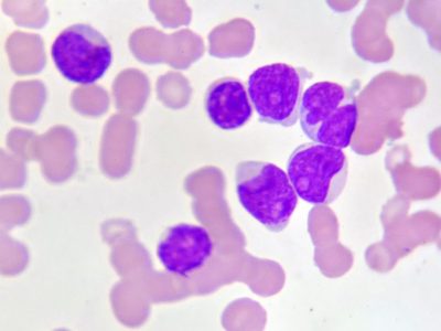 leucemia mieloide aguda