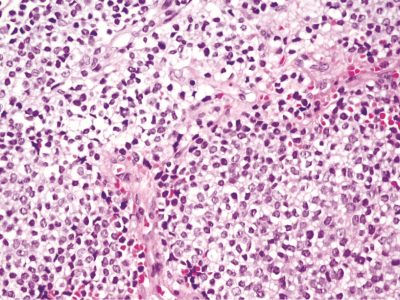 El mecanismo de sensibilidad a la quimoterapia en sarcoma de Ewing abre nuevas vías para estratificar pacientes. Imagen: Adobe Express.