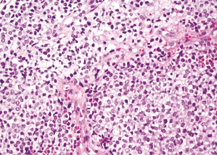 El mecanismo de sensibilidad a la quimoterapia en sarcoma de Ewing abre nuevas vías para estratificar pacientes. Imagen: Adobe Express.