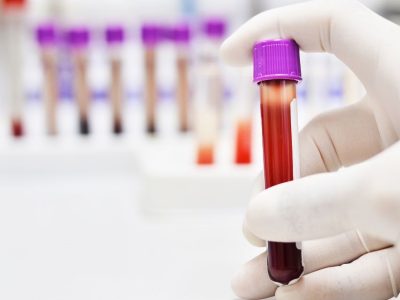 Desarrollan un prototipo de test diagnóstico para detectar el cáncer de páncreas en minutos con una muestra de sangre