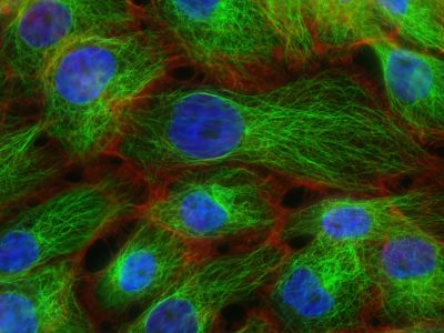 Células tumorales de cáncer de mama. Imagen: National Cancer Institute, Christina Stuelten, Carole Parent, 2011.