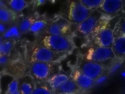 Heterogeneidad en las células  de cáncer de mama triple negativo. Imagen: National Cancer Institute  Univ. of Virginia Cancer Center.