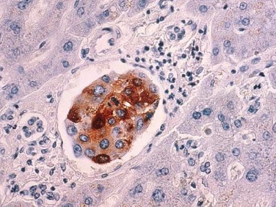 Células de cáncer de mama que han metastatizado al hígado. Imagen: National Cancer Institute, NIH, EEUU.