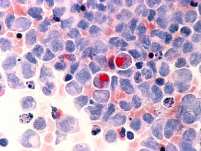 leucemia mieloide aguda