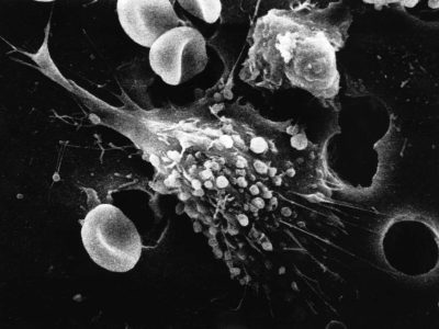 En el caso del cáncer, el número de mutaciones que se adquieren tras el inicio del proceso tumoral no dependen de la edad, sino del tiempo que transcurre entre la primera mutación inductora y la fase de expansión clonal de la enfermedad. Imagen: Célula tumoral migrando. Dr. Raowf Guirguis. National Cancer Institute.