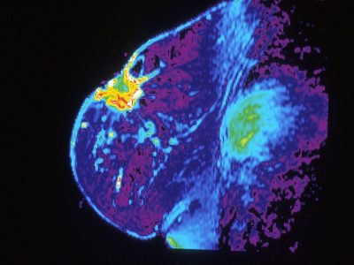 Imagen por resonancia magnética de un pecho. Imagen: Dr. Steven Harmes. Baylor University Medical Center (National Institute of Cancer).