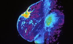 Imagen por resonancia magnética de un pecho. Imagen: Dr. Steven Harmes. Baylor University Medical Center (National Institute of Cancer).