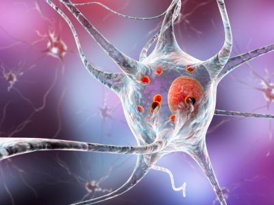 La ELA es una enfermedad neurodegenerativa que afecta a las neuronas del sistema nervioso central y que está caracterizada por una debilidad muscular progresiva.  Imagen: Science Photo Library, via Canva.
