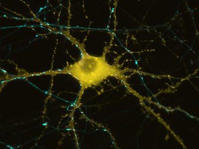 La enfermedad de Parkinson se caracteriza por la disminución de neuronas dopaminérgicas en el mesencéfalo. Imagen: Neurona UC San Diego School of Medicine.