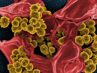 Diagnóstico de la sepsis