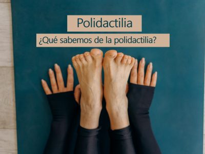 polidactilia