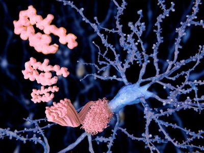 mayores niveles de proteina amiloide en personas con herencia materna de alzheimer