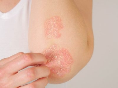 La psoriasis es una enfermedad inflamatoria crónica de la piel que se caracteriza por la formación de lesiones localizadas en la piel. Imagen: Getty, vía Canva