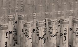 La presencia de mutaciones en TERT en la orina estaba relacionada con un riesgo aumentado de recurrencia del cáncer.