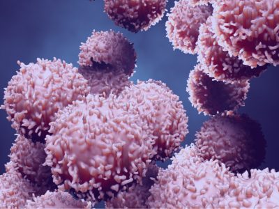 Es posible restablecer la producción de insulina mediante el trasplante de células pancreáticas genéticamente modificadas.