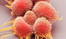 El oncogén MYC tiene un papel importante en muchos tipos de cáncer. Imagen: Células tumorales. Science Photo Library, vía Canva.