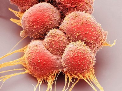 El oncogén MYC tiene un papel importante en muchos tipos de cáncer. Imagen: Células tumorales. Science Photo Library, vía Canva.