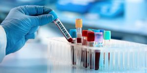 un análisis de sangre revela cambios tempranos en la enfermedad de Parkinson