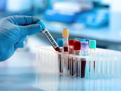 un análisis de sangre revela cambios tempranos en la enfermedad de Parkinson