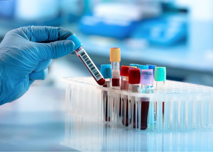 un análisis de sangre revela cambios tempranos en la enfermedad de Parkinson