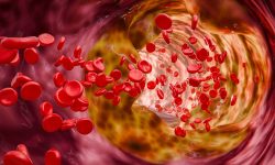 un estudio identifica respuesta inmunitaria anomala en arterosclerosis y desarrolla terapia experimental