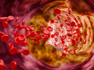 un estudio identifica respuesta inmunitaria anomala en arterosclerosis y desarrolla terapia experimental