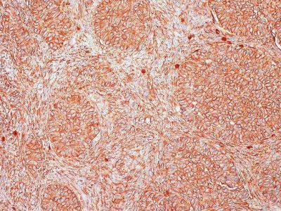 Los cánceres de ovario y endometrio constituyen las enfermedades ginecológicas más agresivas y letales en Europa y Estados Unidos. Imagen: Presencia de la proteína vimentina (en rojo) en células de cáncer de ovario. Por Ed Uthman, MD [CC BY 2.0 (https://creativecommons.org/licenses/by/2.0/],